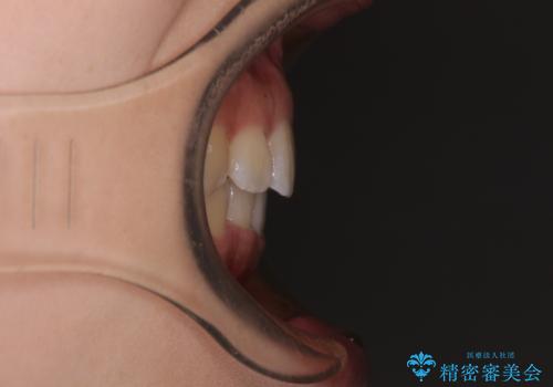 くちばしのような前歯が気になる ワイヤー装置による抜歯矯正治療の治療後