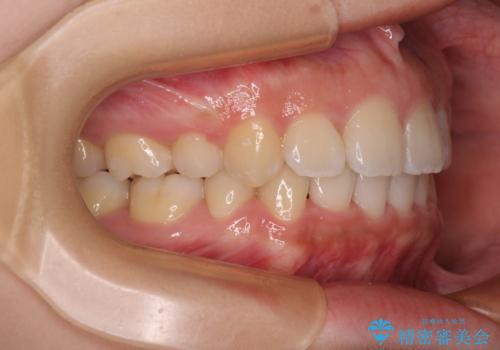 くちばしのような前歯が気になる ワイヤー装置による抜歯矯正治療の治療後