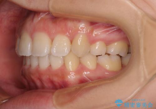 くちばしのような前歯が気になる ワイヤー装置による抜歯矯正治療の治療後