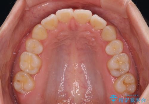 くちばしのような前歯が気になる　ワイヤー装置による抜歯矯正治療の治療後