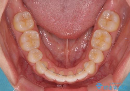 くちばしのような前歯が気になる ワイヤー装置による抜歯矯正治療の治療後