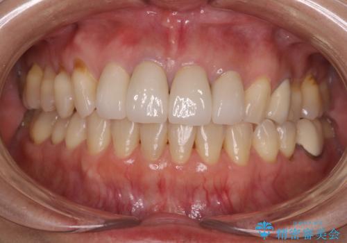 モザイク模様の前歯 オールセラミッククラウンで整った印象にの治療後