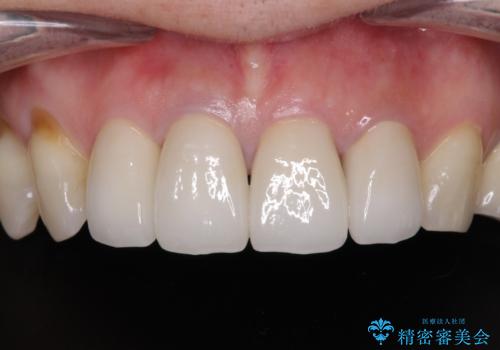 モザイク模様の前歯 オールセラミッククラウンで整った印象にの症例 治療後