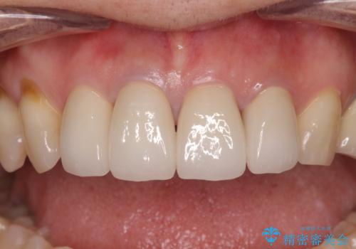 モザイク模様の前歯 オールセラミッククラウンで整った印象にの治療後