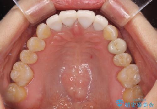 モザイク模様の前歯 オールセラミッククラウンで整った印象にの治療後