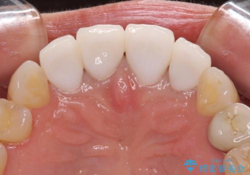 モザイク模様の前歯 オールセラミッククラウンで整った印象にの治療後