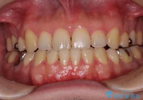 【モニター】舌のトレーニングを行いながら後戻りの再矯正の治療後