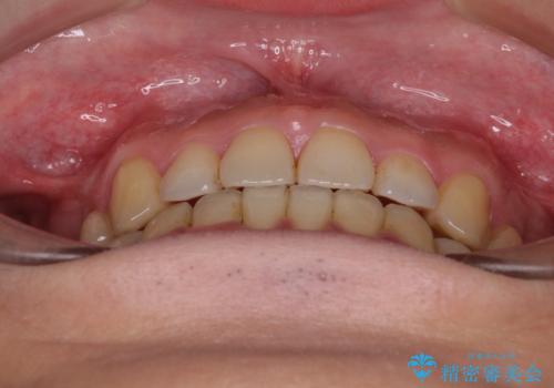 【モニター】舌のトレーニングを行いながら後戻りの再矯正の治療後