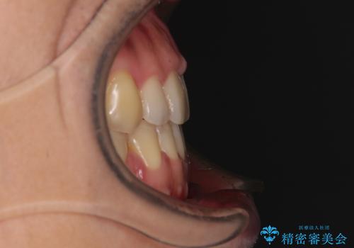 【モニター】舌のトレーニングを行いながら後戻りの再矯正の治療後