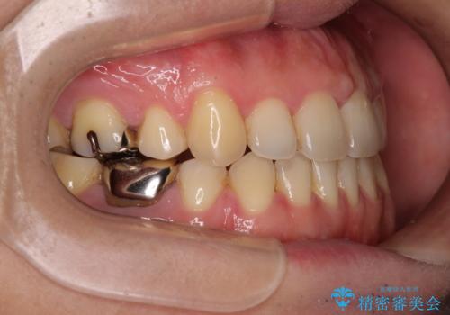 【モニター】舌のトレーニングを行いながら後戻りの再矯正の治療後