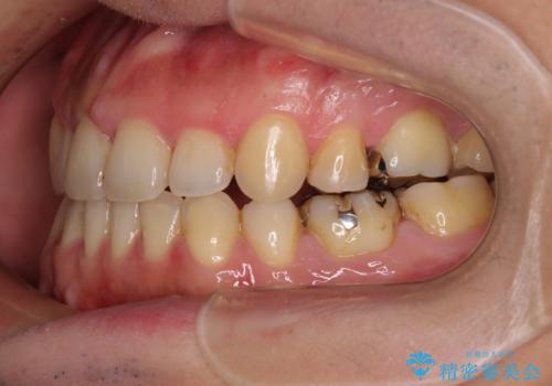 【モニター】舌のトレーニングを行いながら後戻りの再矯正の治療後