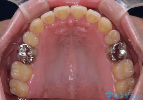 【モニター】舌のトレーニングを行いながら後戻りの再矯正の治療後