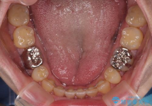 【モニター】舌のトレーニングを行いながら後戻りの再矯正の治療後