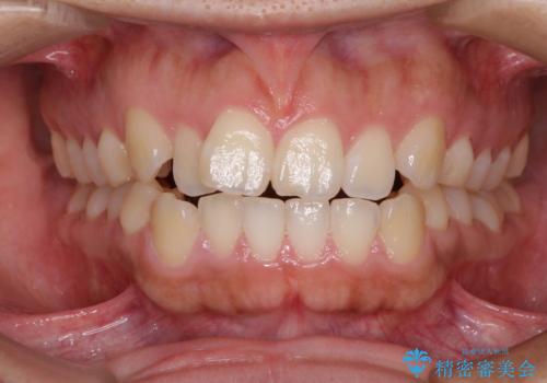 気がつくと唇が開く 口元を下げる抜歯矯正の症例 治療前