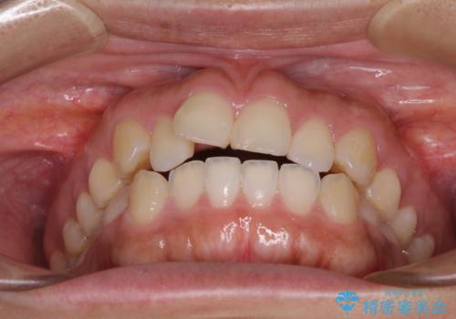 気がつくと唇が開く 口元を下げる抜歯矯正の治療前