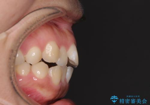 気がつくと唇が開く 口元を下げる抜歯矯正の治療前