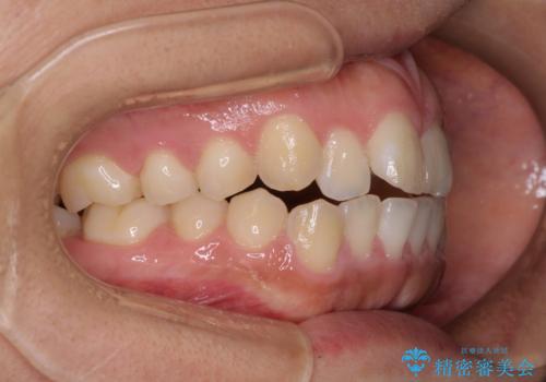 気がつくと唇が開く 口元を下げる抜歯矯正の治療前