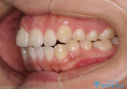 気がつくと唇が開く 口元を下げる抜歯矯正の治療前