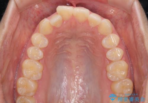 気がつくと唇が開く 口元を下げる抜歯矯正の治療前