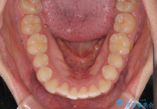 気がつくと唇が開く 口元を下げる抜歯矯正の治療前