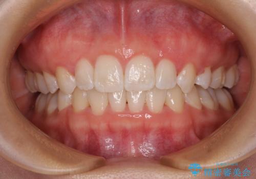 前歯のガタガタを整えたい ワイヤー装置による抜歯矯正治療の症例 治療後