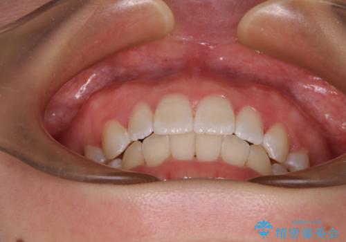 前歯のガタガタを整えたい ワイヤー装置による抜歯矯正治療の治療後