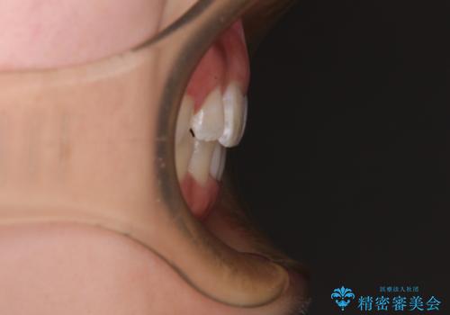 前歯のガタガタを整えたい ワイヤー装置による抜歯矯正治療の治療後