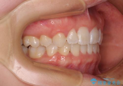 前歯のガタガタを整えたい　ワイヤー装置による抜歯矯正治療の治療後