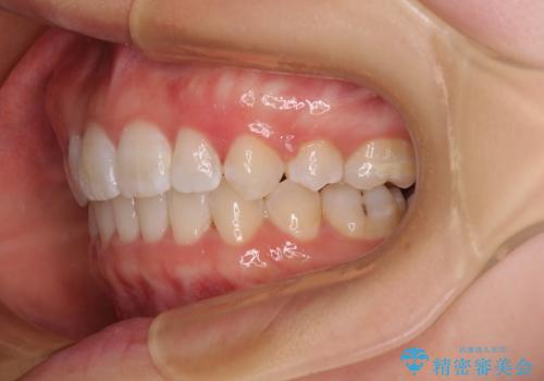前歯のガタガタを整えたい ワイヤー装置による抜歯矯正治療の治療後