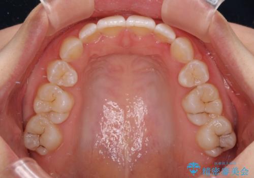 前歯のガタガタを整えたい ワイヤー装置による抜歯矯正治療の治療後