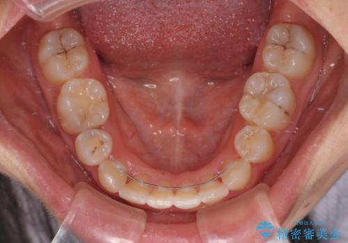 前歯のガタガタを整えたい ワイヤー装置による抜歯矯正治療の治療後