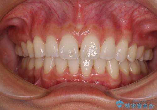 尖った前歯を引っ込めたい　目立たないワイヤー装置での抜歯矯正の症例 治療後