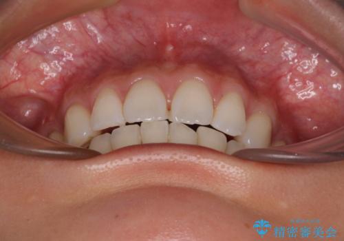 尖った前歯を引っ込めたい 目立たないワイヤー装置での抜歯矯正の治療後