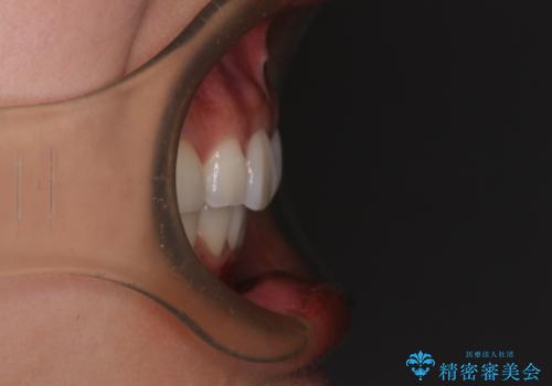 尖った前歯を引っ込めたい 目立たないワイヤー装置での抜歯矯正の治療後