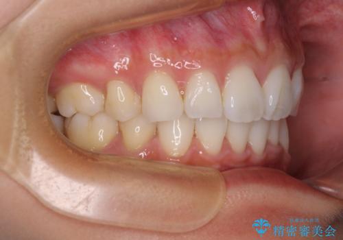 尖った前歯を引っ込めたい 目立たないワイヤー装置での抜歯矯正の治療後