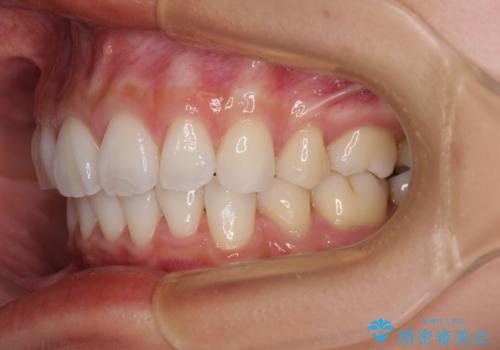 尖った前歯を引っ込めたい 目立たないワイヤー装置での抜歯矯正の治療後