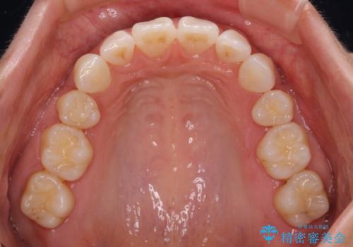 尖った前歯を引っ込めたい 目立たないワイヤー装置での抜歯矯正の治療後