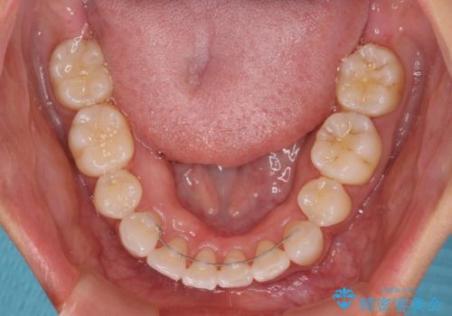 尖った前歯を引っ込めたい 目立たないワイヤー装置での抜歯矯正の治療後