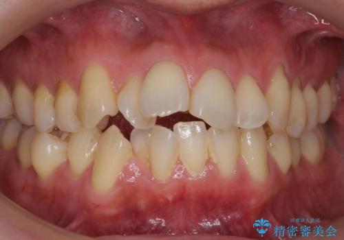 出っ歯をしっかり引っ込めたい