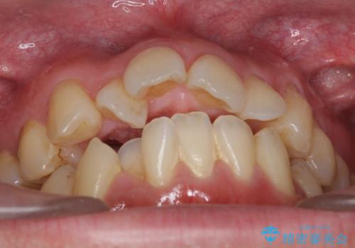 出っ歯をしっかり引っ込めたいの治療前