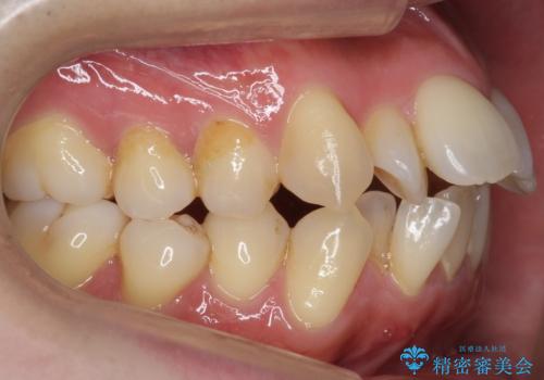 出っ歯をしっかり引っ込めたいの治療前