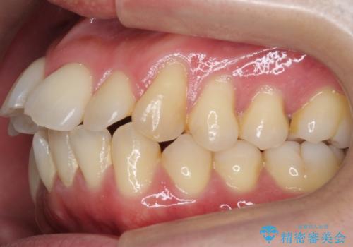 出っ歯をしっかり引っ込めたいの治療前