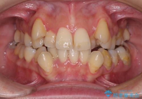 【モニター】上下の八重歯を治したい ワイヤー装置による矯正治療の症例 治療前
