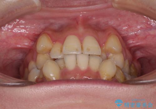 【モニター】上下の八重歯を治したい ワイヤー装置による矯正治療の治療前