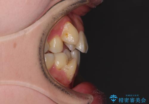 【モニター】上下の八重歯を治したい ワイヤー装置による矯正治療の治療前