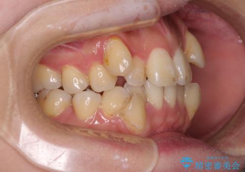 【モニター】上下の八重歯を治したい ワイヤー装置による矯正治療の治療前