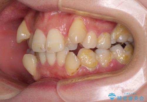 【モニター】上下の八重歯を治したい ワイヤー装置による矯正治療の治療前