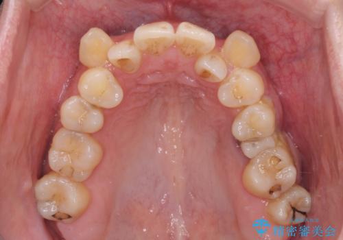 【モニター】上下の八重歯を治したい ワイヤー装置による矯正治療の治療前