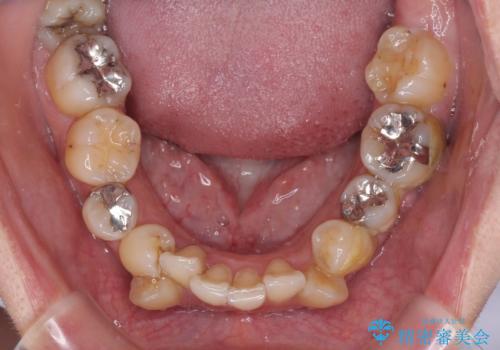 【モニター】上下の八重歯を治したい ワイヤー装置による矯正治療の治療前