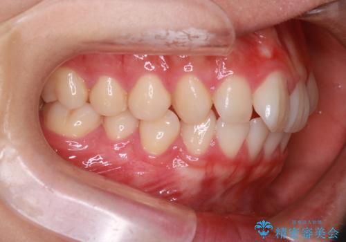 【インビザライン】前歯のねじれを治したい。の治療前